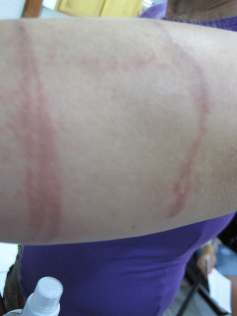 skin irritation from a jellyfish sting redened stripes where the person was stung